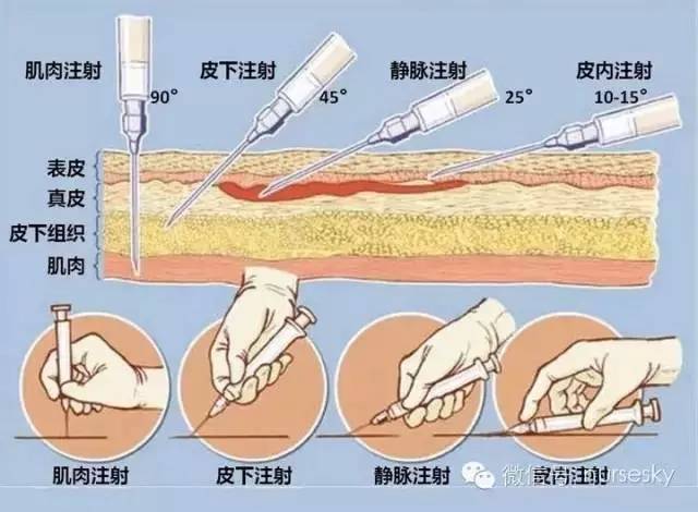 各种注射法的进针角度