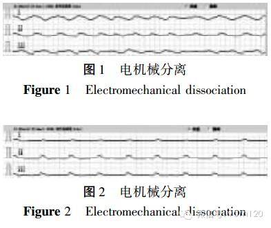 将心脏停搏分为三型:(1)心室颤动(心脏不能搏血);(2)电-机械分离(心肌