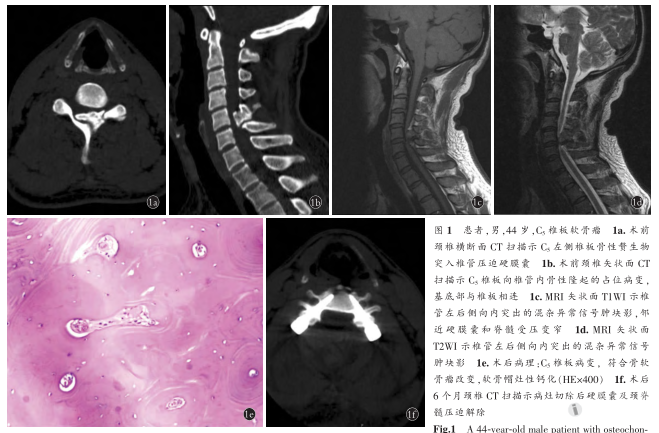 病例:颈椎椎板骨软骨瘤1例