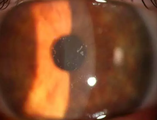 【最新研究进展】角膜上皮清创术与磨镶术治疗角膜上皮不平及复发性角膜糜烂的长期疗效分析