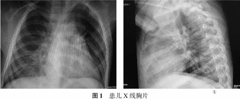 病例:博卡病毒及腺病毒混合感染儿童肺炎一例