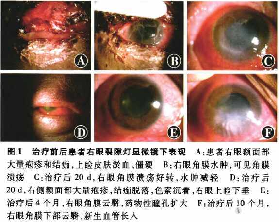 病例:眼部出血性带状疱疹一例