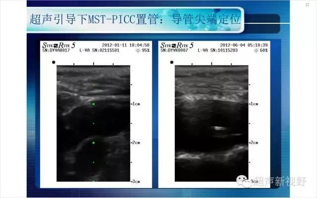 超声引导下picc置管