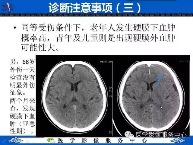 硬膜外血肿与硬膜下血肿的ct鉴别