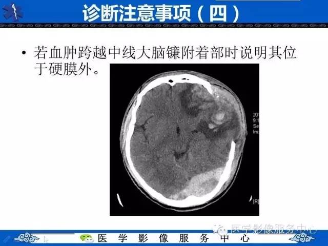 硬膜外血肿与硬膜下血肿的ct鉴别