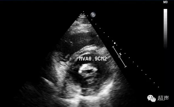 二尖瓣狭窄超声特点