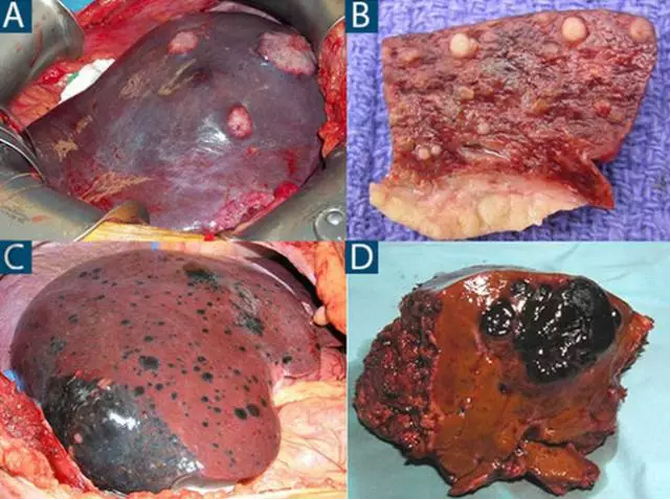 有图有真相!图解7种常见肝脏肿瘤—恶性篇