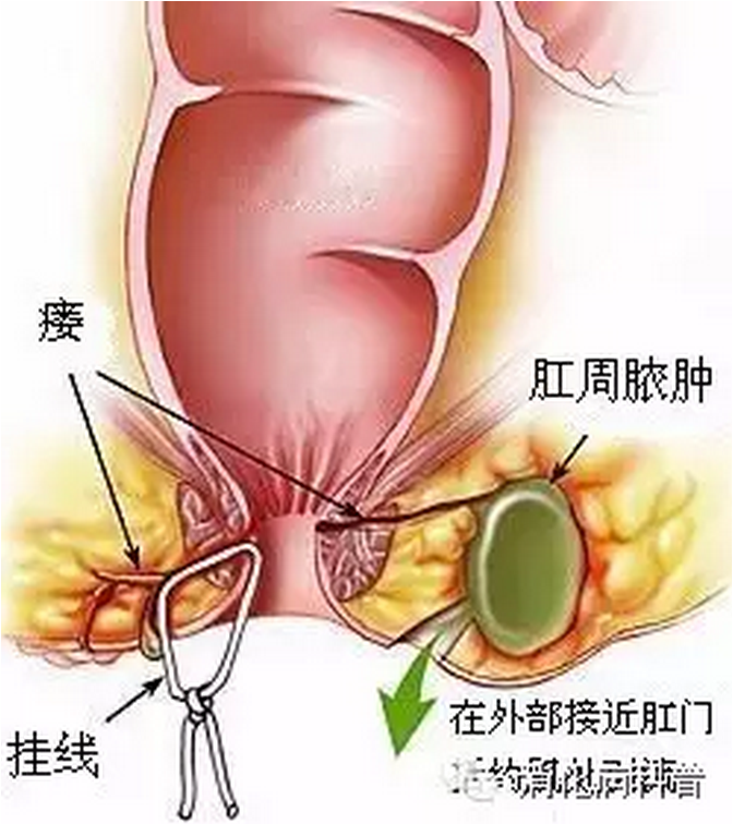 比痔疮危害更大的肛肠疾病:肛瘘