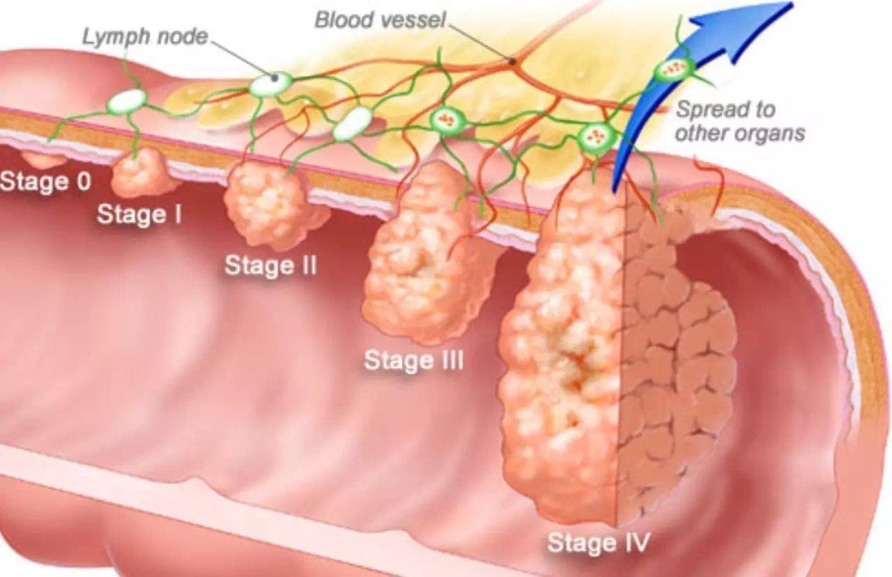 结直肠癌tnm分期