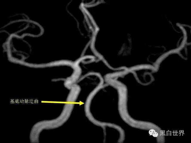 解剖基础:基底动脉常见变异