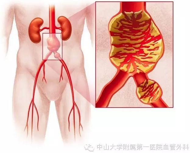 人体"不定时炸弹"(上篇)| 腹主动脉瘤究竟有多可怕?