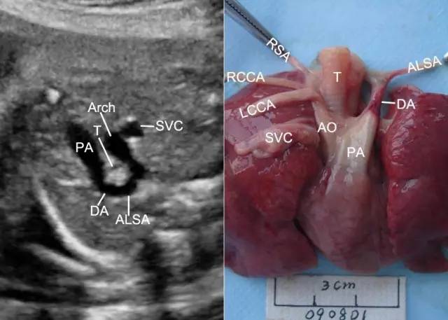 切面诊断胎儿双主动脉弓及右位主动脉弓伴左侧动脉导管这两种完全性