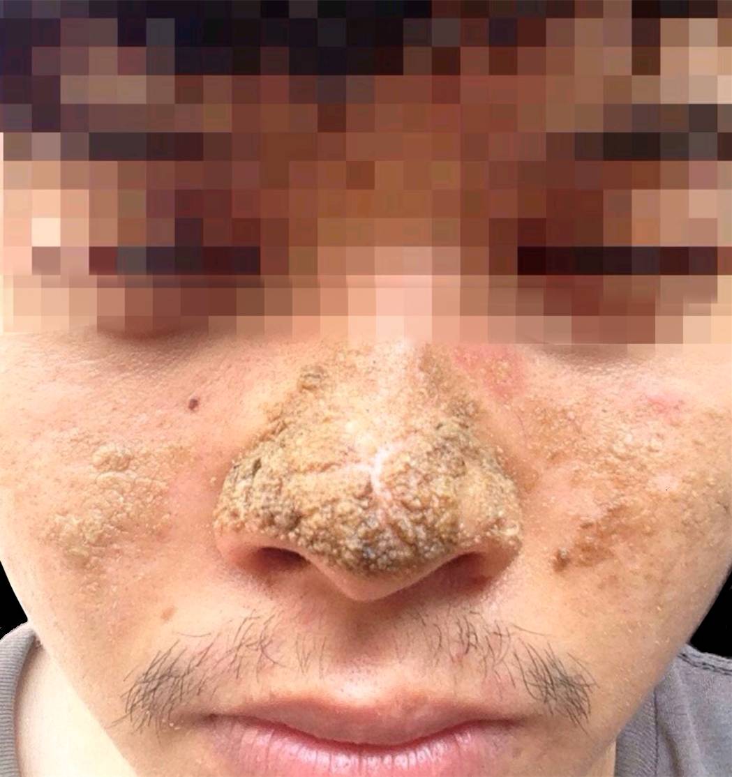 皮肤垢着病一例