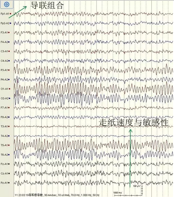 实战图形教你掌握正常成人脑电图