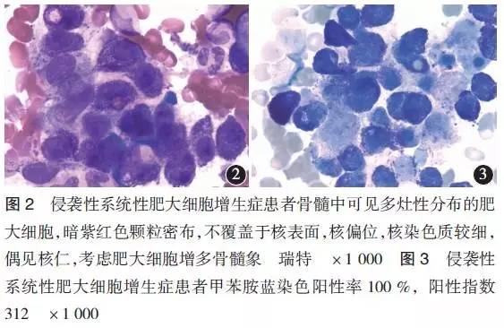 pas染色示粒红系各阶段细胞可见,巨核细胞不少见,网状纤维染色(-)