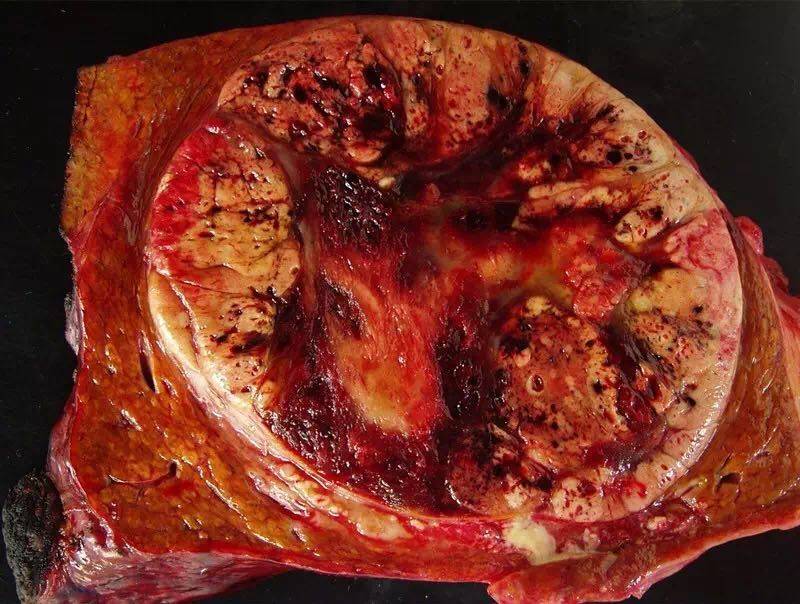 多图:常见肝脏肿瘤之恶性篇