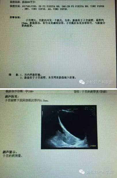疤痕子宫孕晚期因胎儿畸形的引产相关问题