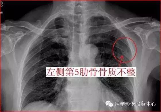 如何看x线片上的肋骨骨折