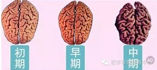 脑萎缩与硬膜下积液如何鉴别