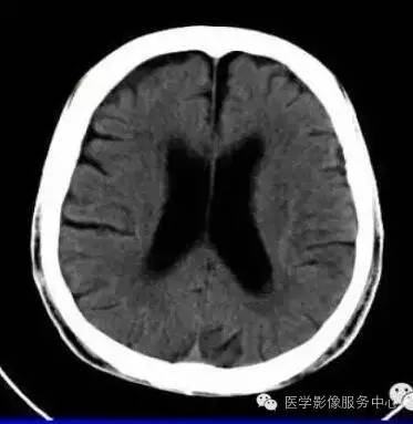 脑萎缩与硬膜下积液如何鉴别