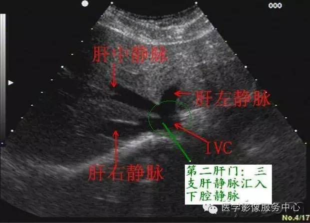 带你认识b超下的肝脏解剖图谱