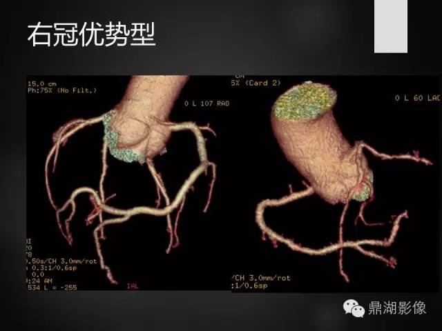 冠脉动脉的解剖与冠脉造影