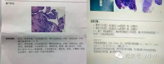 手把手教你读懂胃镜报告单