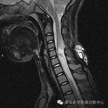 脊柱裂(隐性脊柱裂,脊膜膨出,脊髓脊膜膨出)的影像学