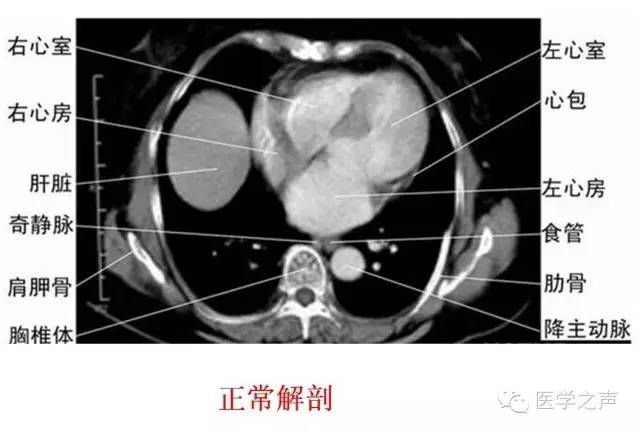 心包积液的ct诊断及液体量评估