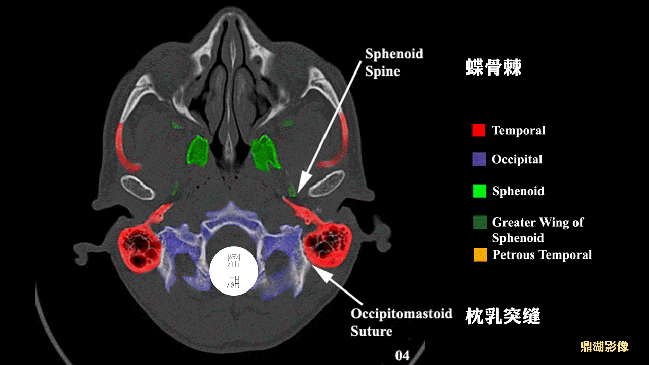 超精致颅底ct断层解剖