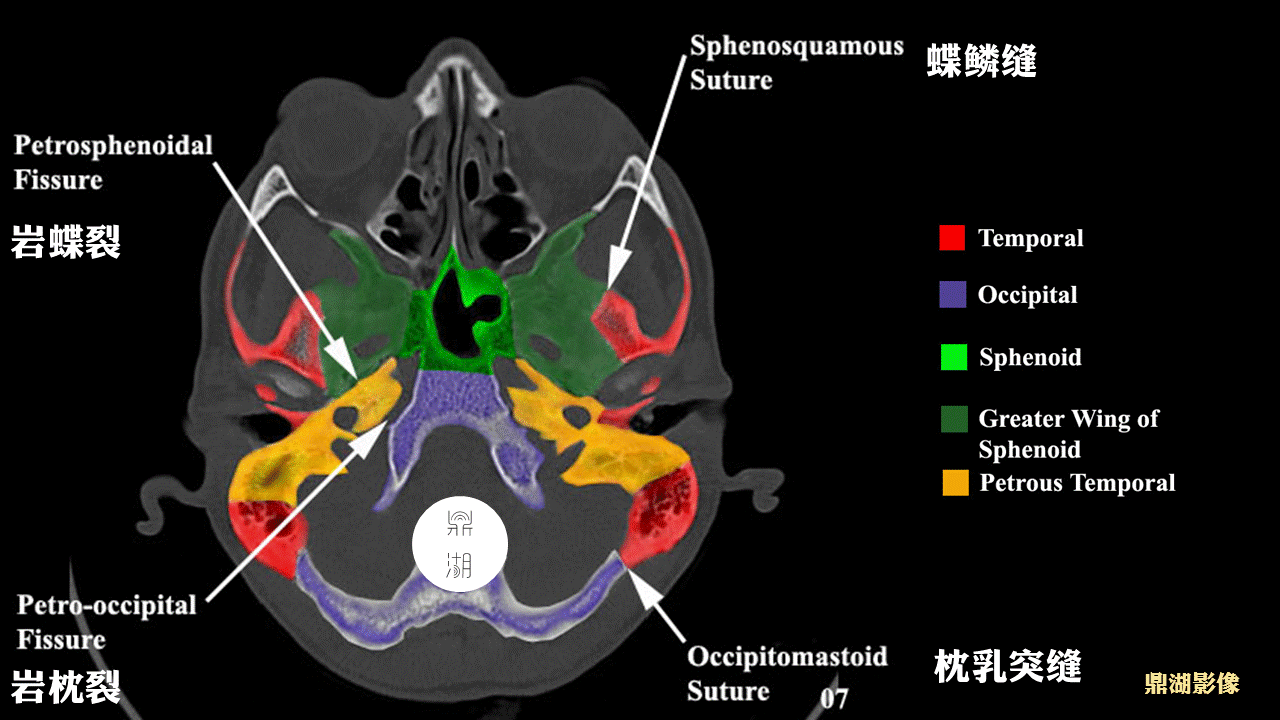 超精致颅底ct断层解剖