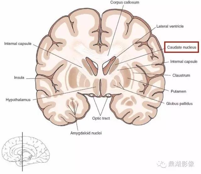 尾状核 外形侧面观略呈豆点状,头部膨大,突人侧脑室前角内,构成侧