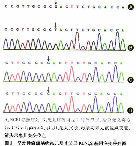 kcnq2基因无义突变所致早发性癫痫脑病一例