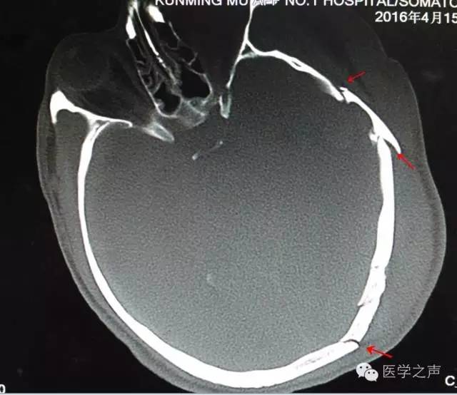 颅骨骨折的ct表现及诊断