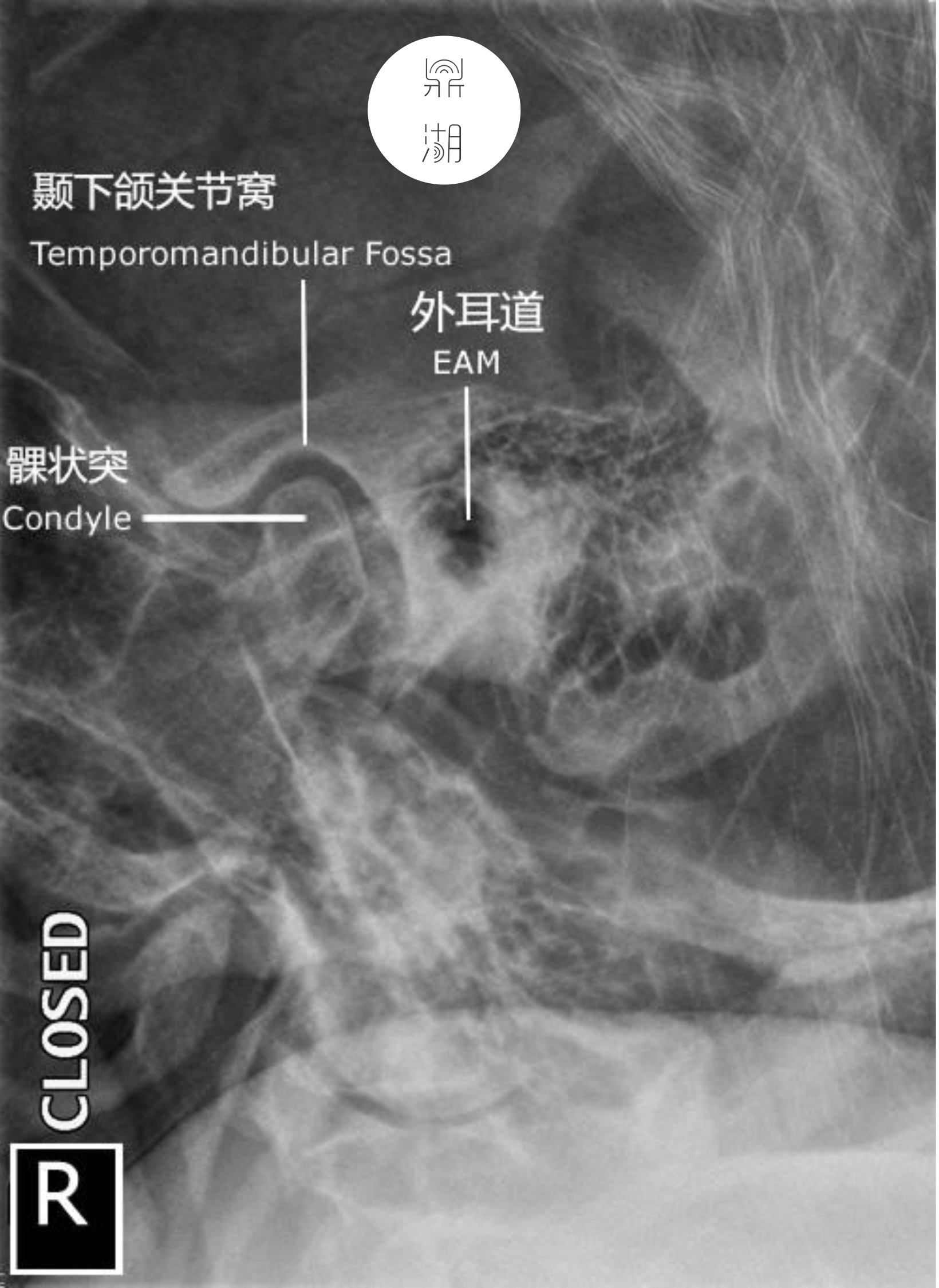x线解剖 | 颞下颌关节解剖
