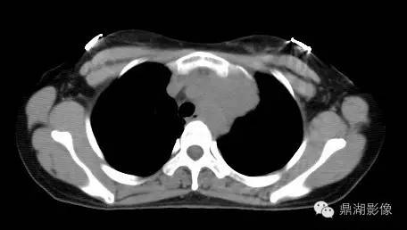 纵隔淋巴瘤ct表现
