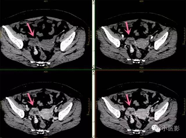 讨论:  卵巢浆液性乳头状腺癌钙化性转移表现出独特的ct