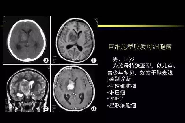 多形性胶质母细胞瘤影像学表现