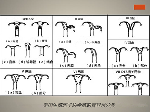 【病例解读】单角子宫残角妊娠一例