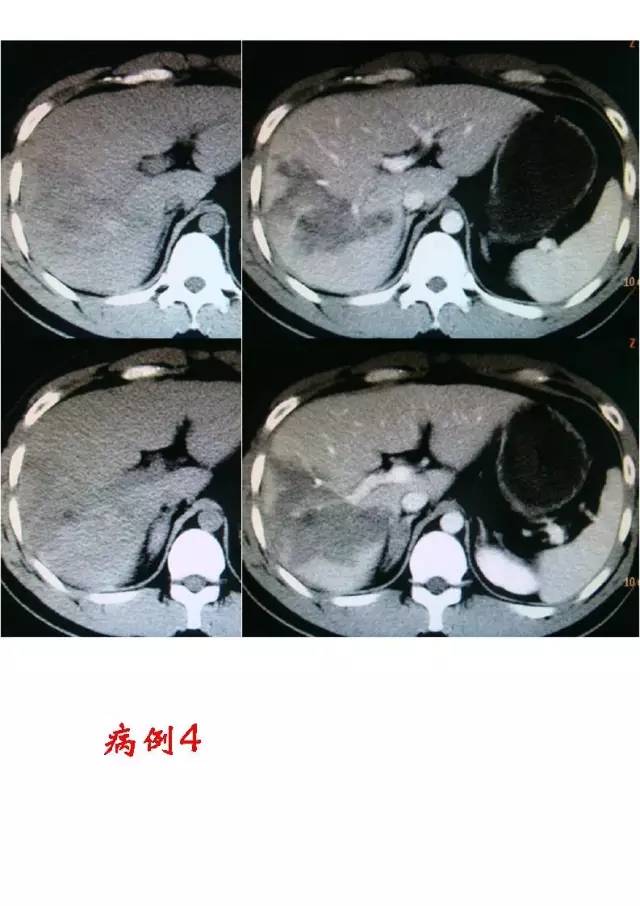 肝脏损伤的影像学表现及诊断