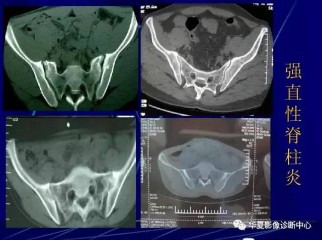 骶髂关节退变,强直,致密性髂骨炎在ct上如何区分
