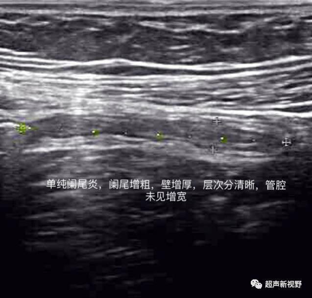 急性阑尾炎的超声诊断