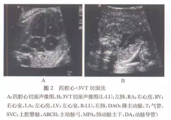 四腔心切面 3vt 切面法(见图 2):声束平面横切胎儿胸腔获得四腔心切面