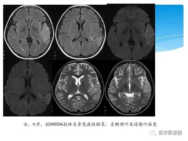 自身免疫性脑炎是怎么回事 自身免疫性脑炎的发病原因