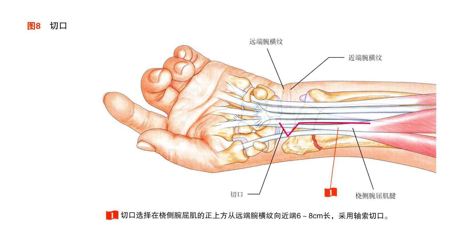 桡骨远端粉碎性骨折掌背侧手术入路疗效比较