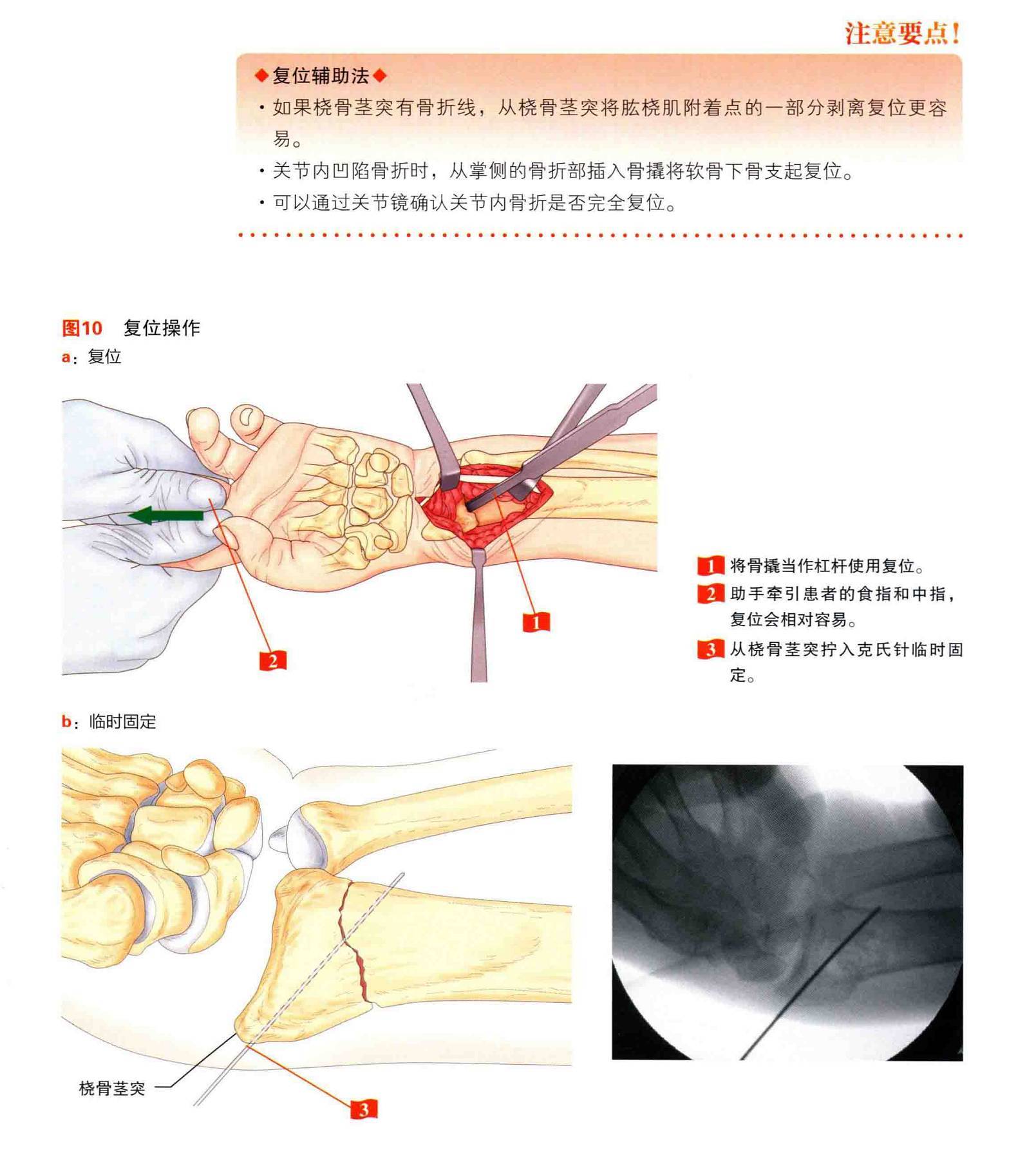 桡骨远端骨折钢板固定的手术技巧