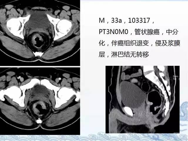 ct检查及诊断攻略—胃癌,结直肠癌