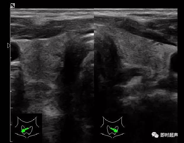 甲状腺超声检查