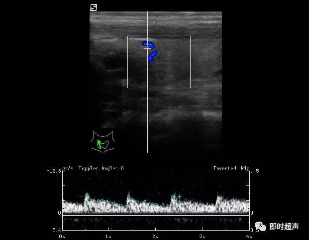 甲状腺超声检查