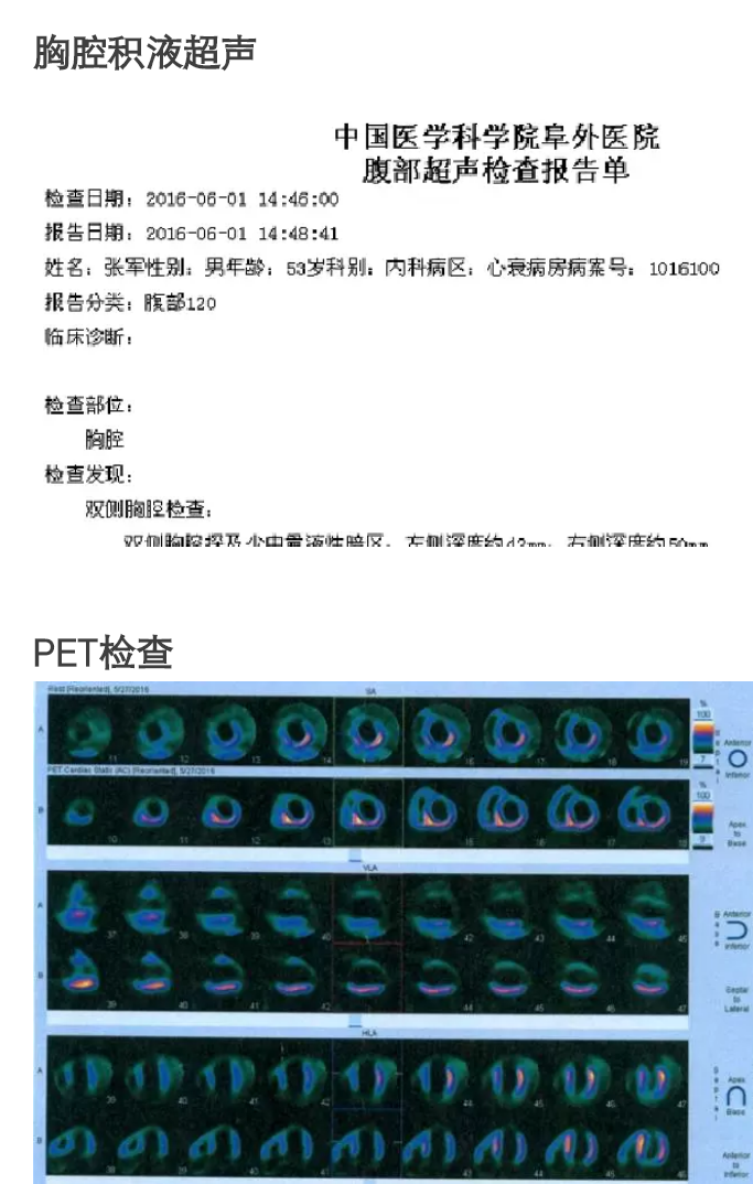 胸腔积液超声